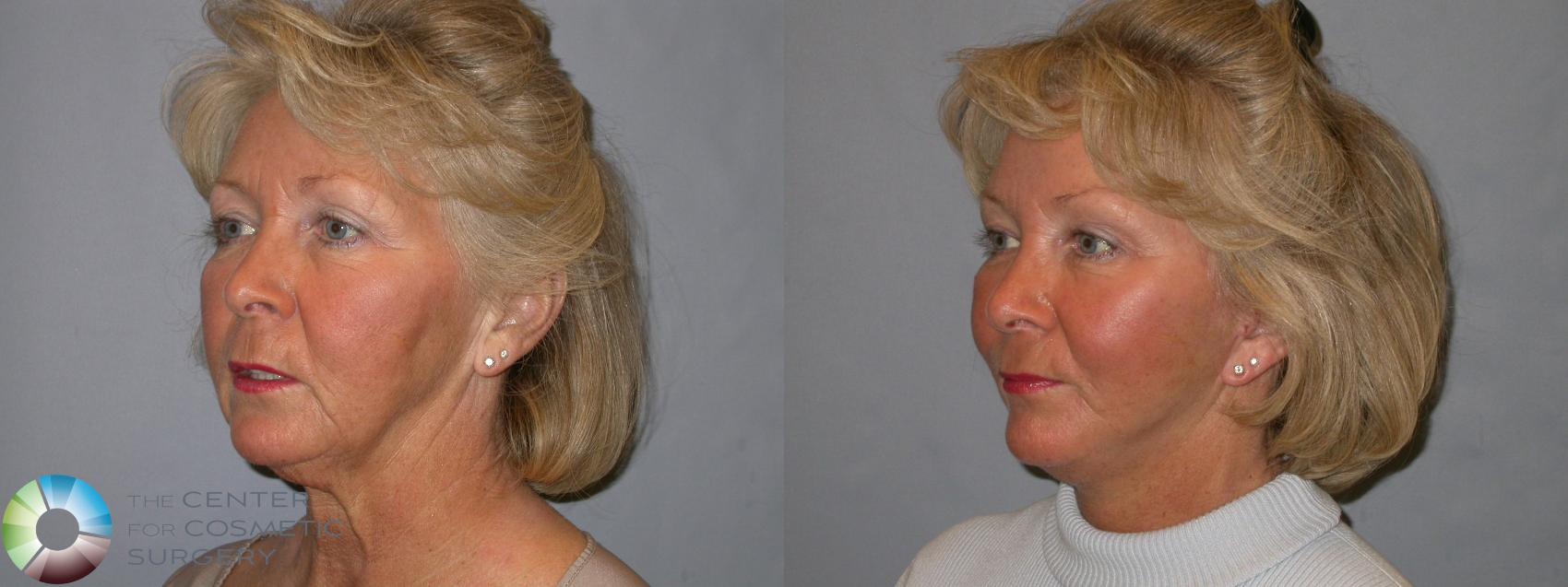 Before & After Mini Facelift Case 136 View #2 in Denver and Colorado Springs, CO