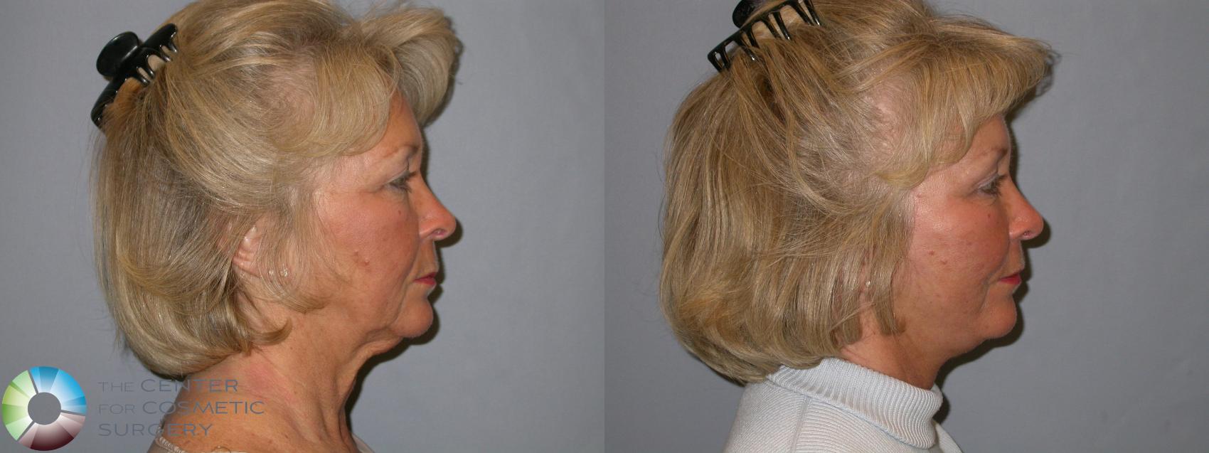 Before & After Mini Facelift Case 136 View #3 in Denver and Colorado Springs, CO