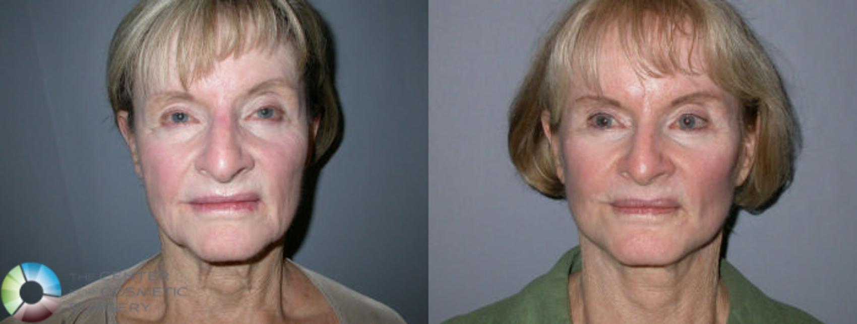Before & After Mini Facelift Case 14 View #1 in Denver and Colorado Springs, CO