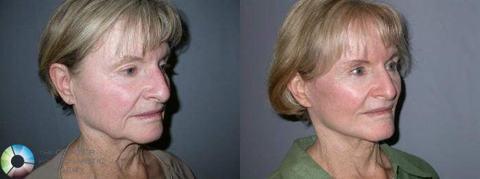 Before & After Mini Facelift Case 14 View #2 in Denver and Colorado Springs, CO