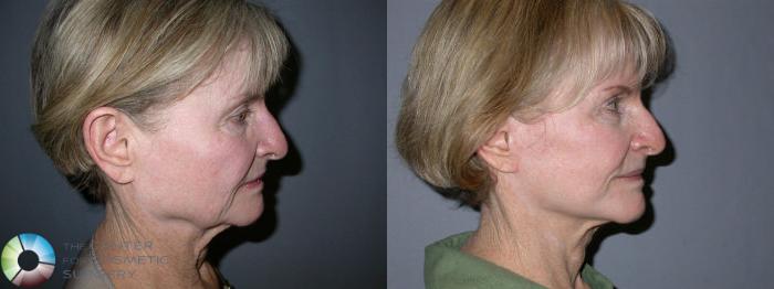 Before & After Mini Facelift Case 14 View #3 in Denver and Colorado Springs, CO