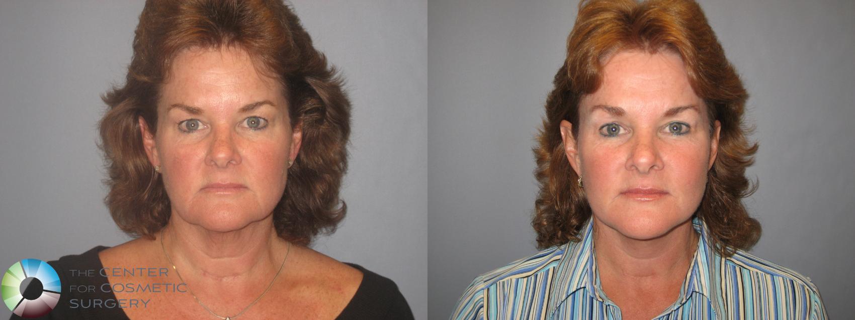 Before & After Eyelid Lift Case 147 View #1 View in Golden, CO