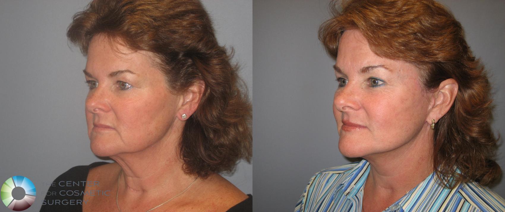 Before & After Mini Facelift Case 147 View #2 View in Golden, CO
