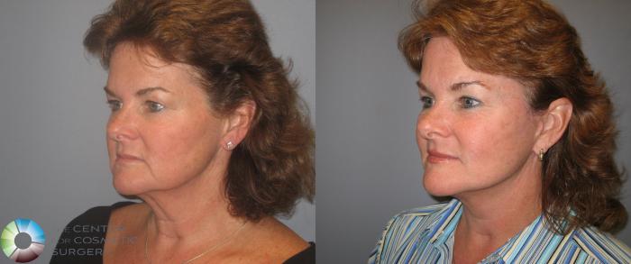 Before & After Eyelid Lift Case 147 View #2 View in Golden, CO