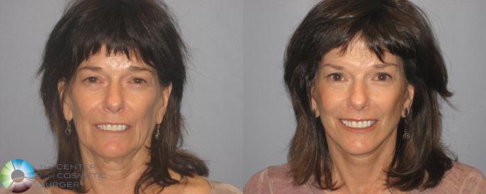 Before & After Eyelid Lift Case 148 View #1 View in Golden, CO