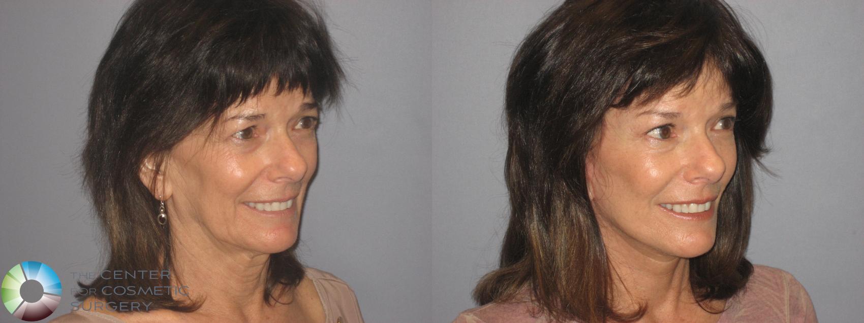 Before & After Mini Facelift Case 148 View #2 View in Golden, CO