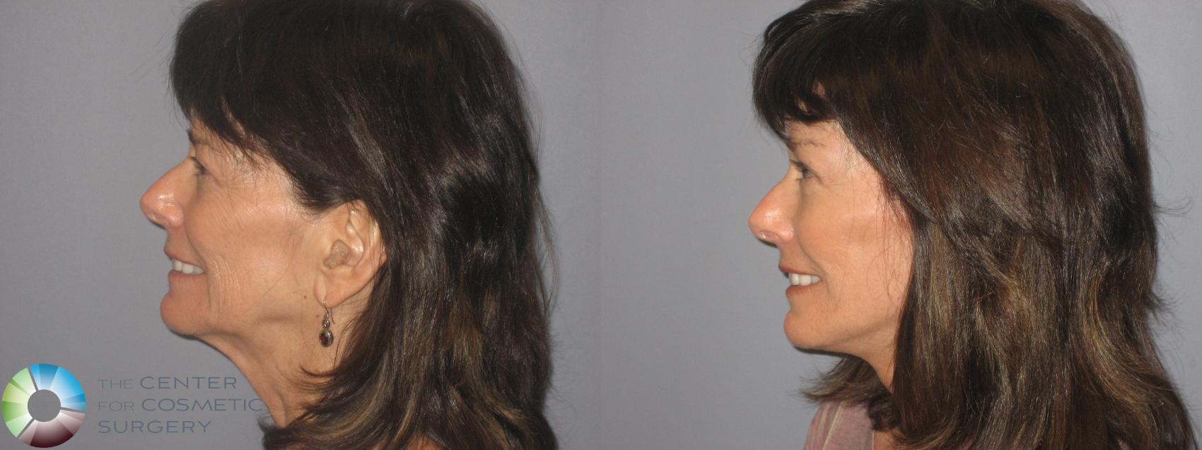 Before & After Mini Facelift Case 148 View #3 View in Denver & Golden, CO