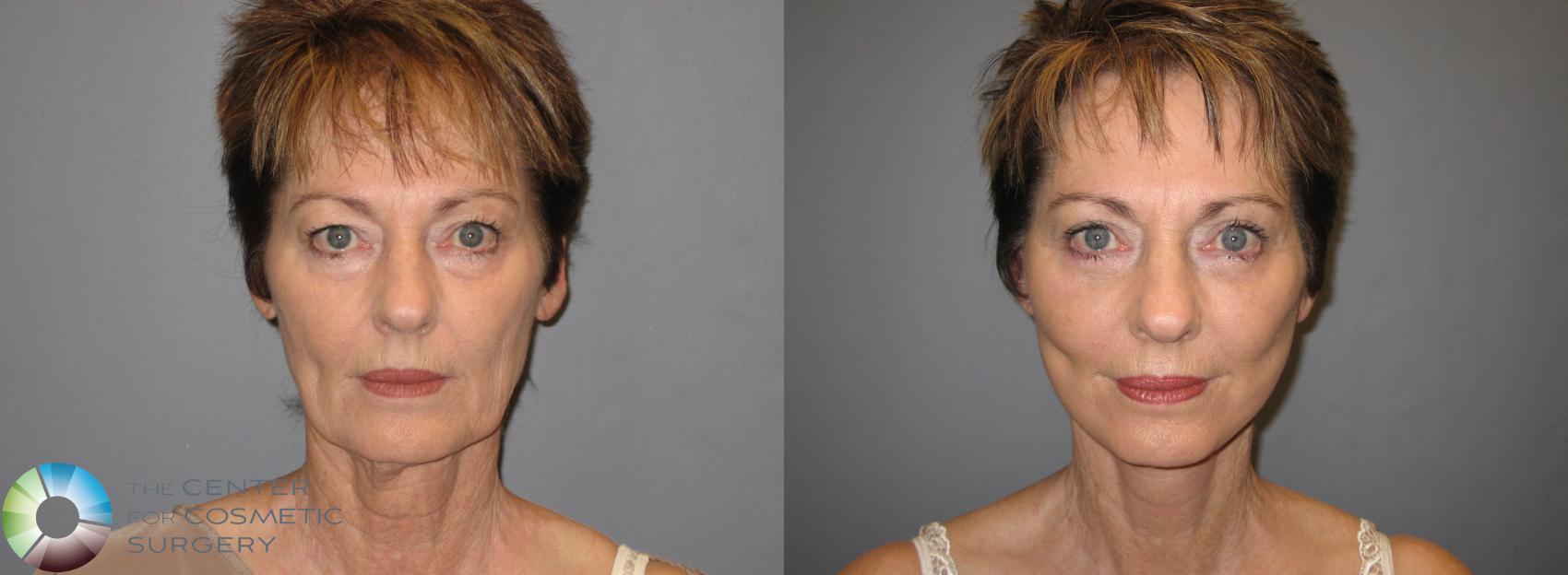 Before & After Mini Facelift Case 153 View #1 View in Golden, CO