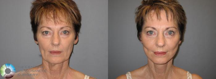Before & After Eyelid Lift Case 153 View #1 in Denver, CO
