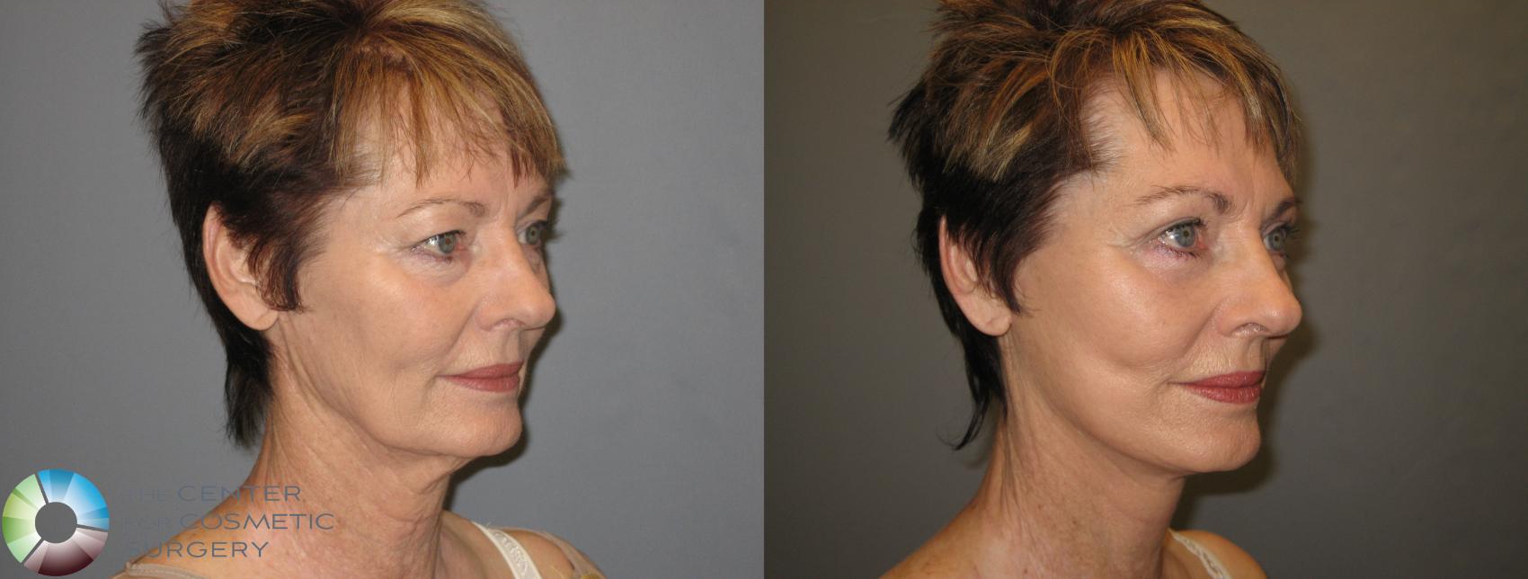 Before & After Mini Facelift Case 153 View #2 View in Golden, CO