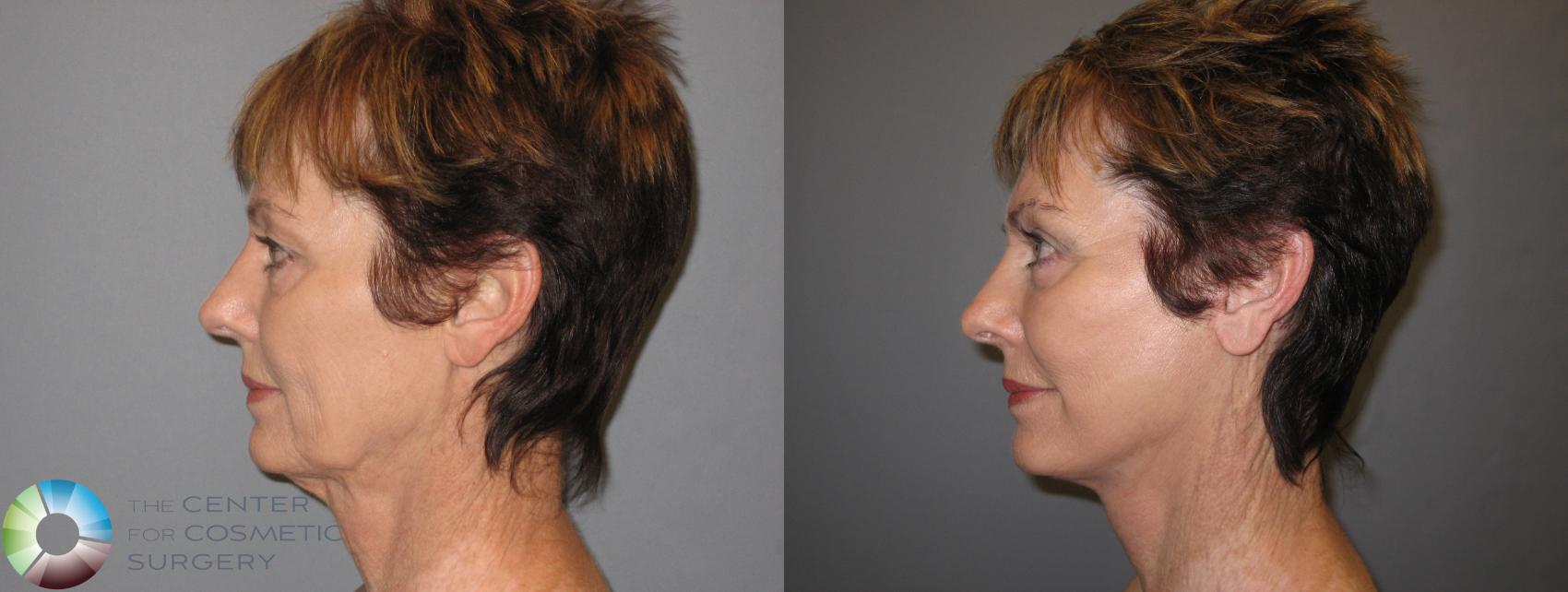 Before & After Mini Facelift Case 153 View #3 View in Golden, CO