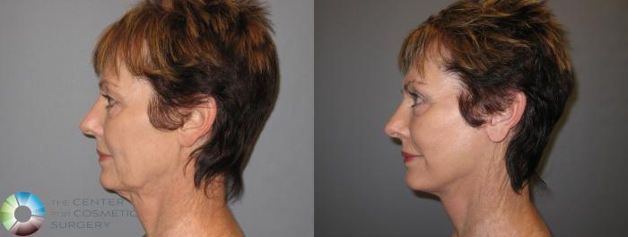 Before & After Mini Facelift Case 153 View #3 in Denver and Colorado Springs, CO