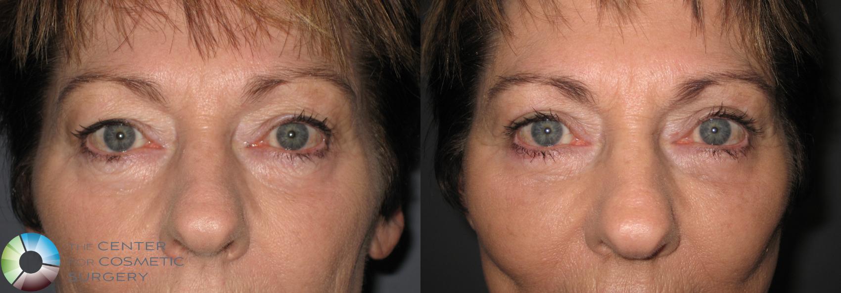 Before & After Mini Facelift Case 153 View #4 View in Golden, CO