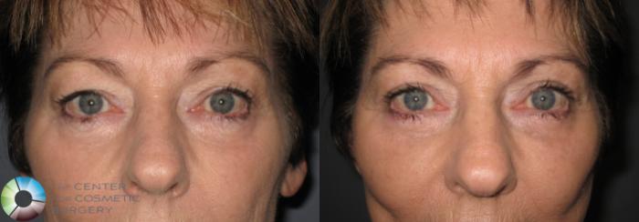 Before & After Eyelid Lift Case 153 View #4 in Denver, CO