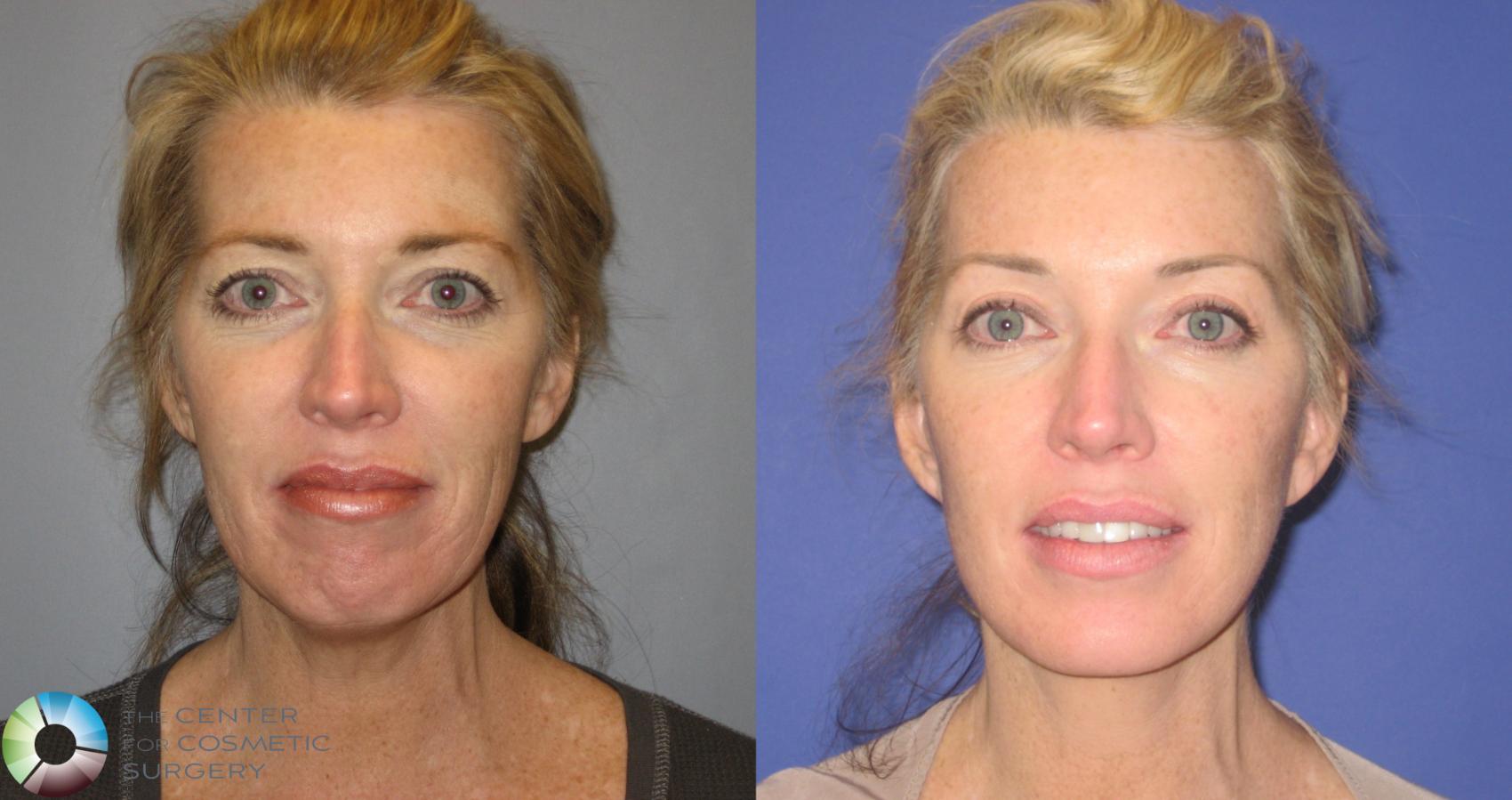 Before & After Facelift Case 155 View #1 in Denver and Colorado Springs, CO