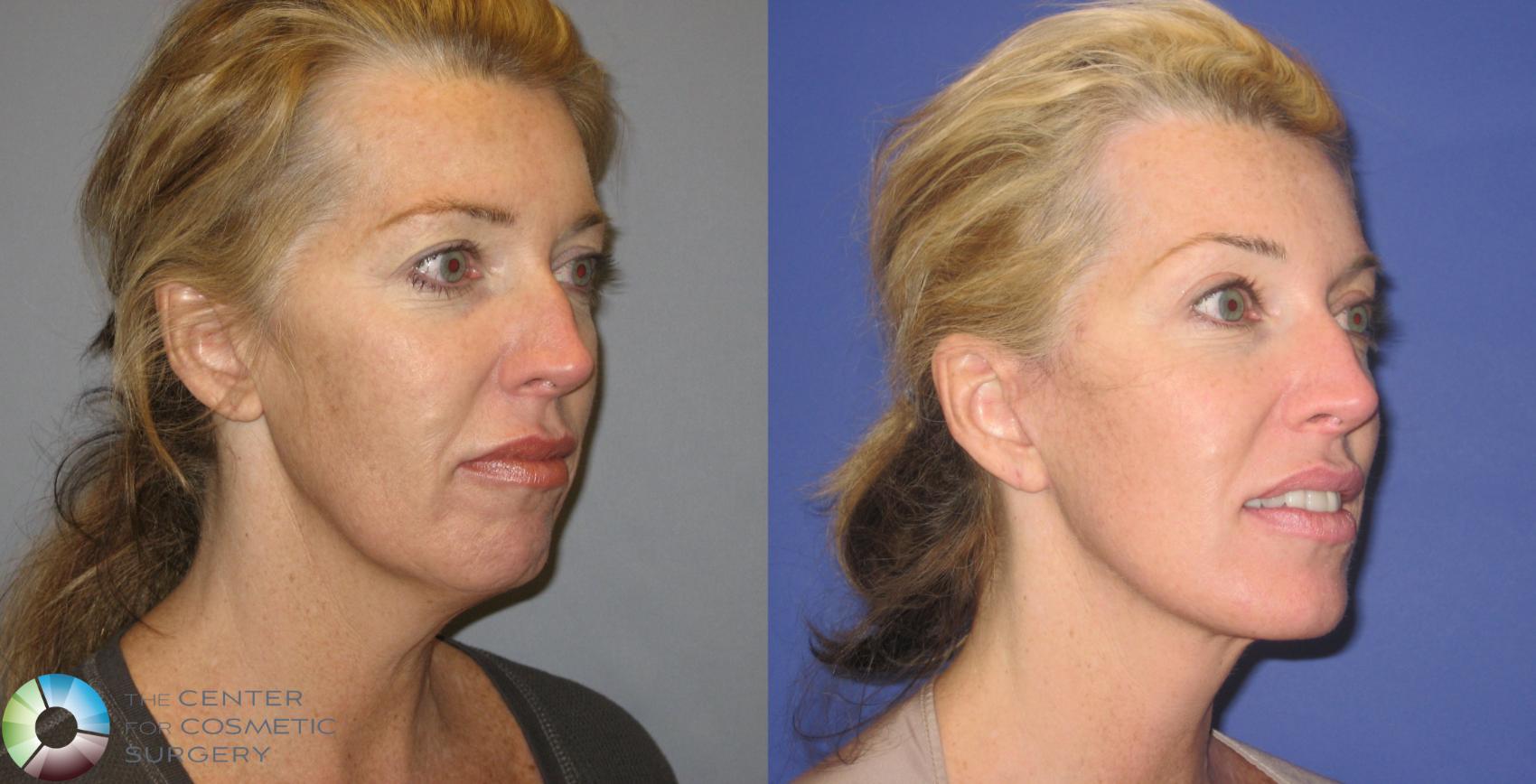 Before & After Eyelid Lift Case 155 View #2 View in Denver & Golden, CO