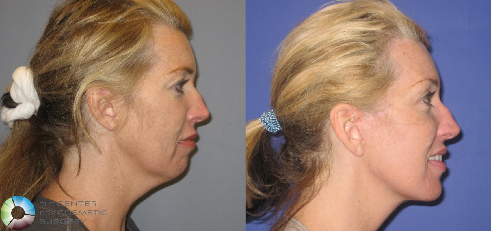 Before & After Mini Facelift Case 155 View #3 View in Denver & Golden, CO