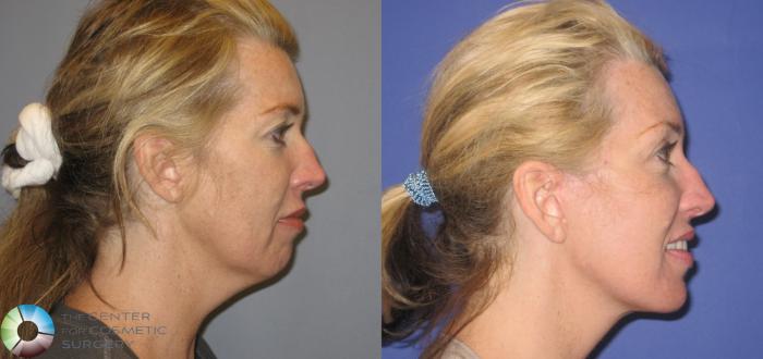 Before & After Facelift Case 155 View #3 View in Golden, CO