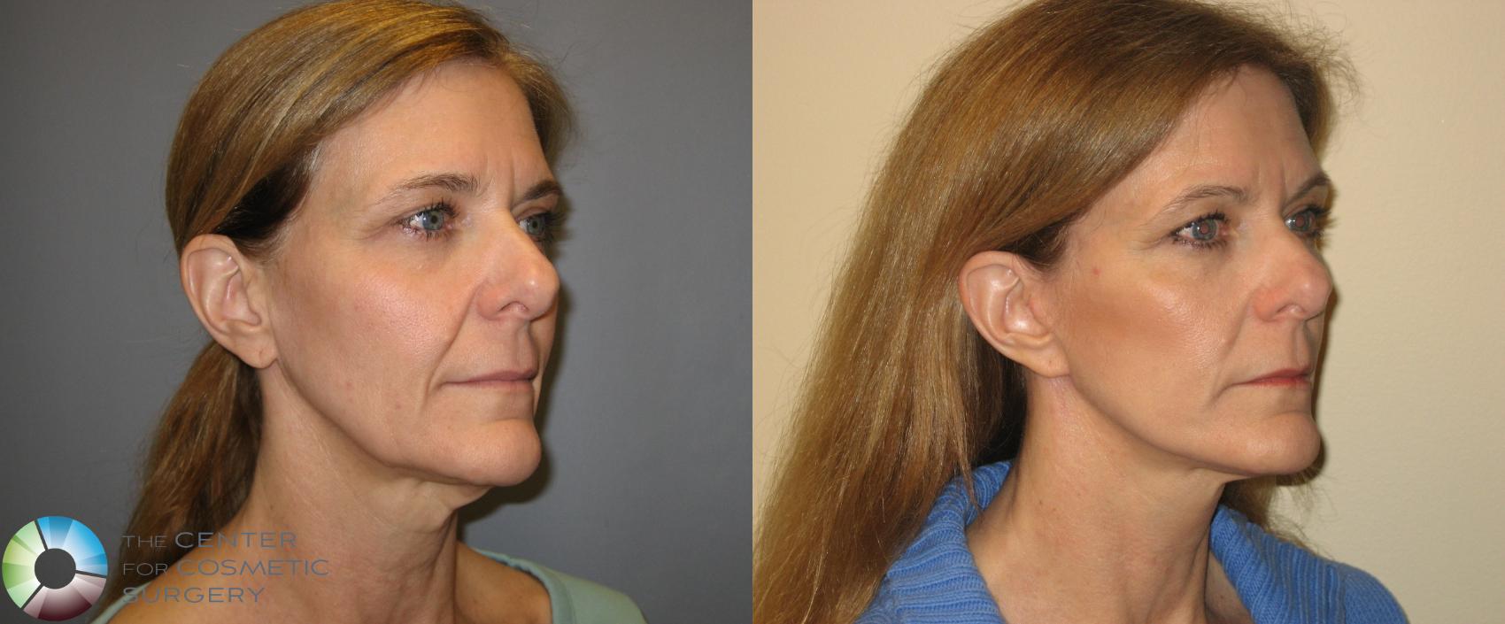 Before & After Mini Facelift Case 167 View #1 in Denver and Colorado Springs, CO