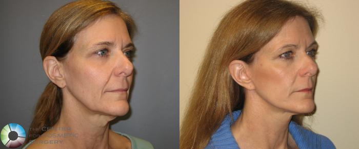 Before & After Mini Facelift Case 167 View #1 View in Golden, CO