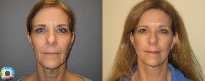 Before & After Mini Facelift Case 167 View #2 View in Golden, CO
