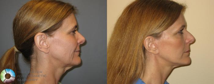 Before & After Mini Facelift Case 167 View #3 View in Golden, CO