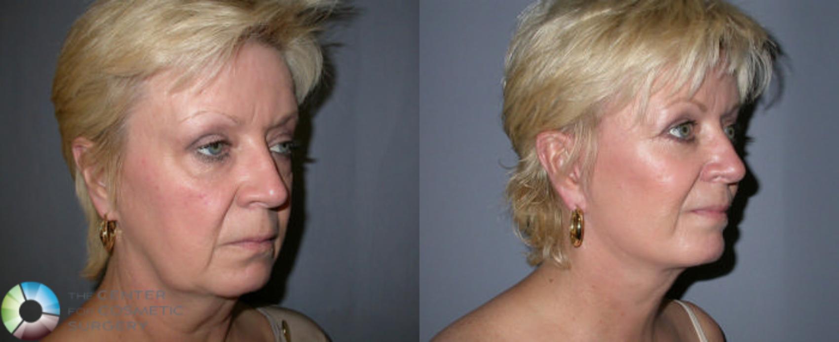 Before & After Mini Facelift Case 2 View #1 in Denver, CO