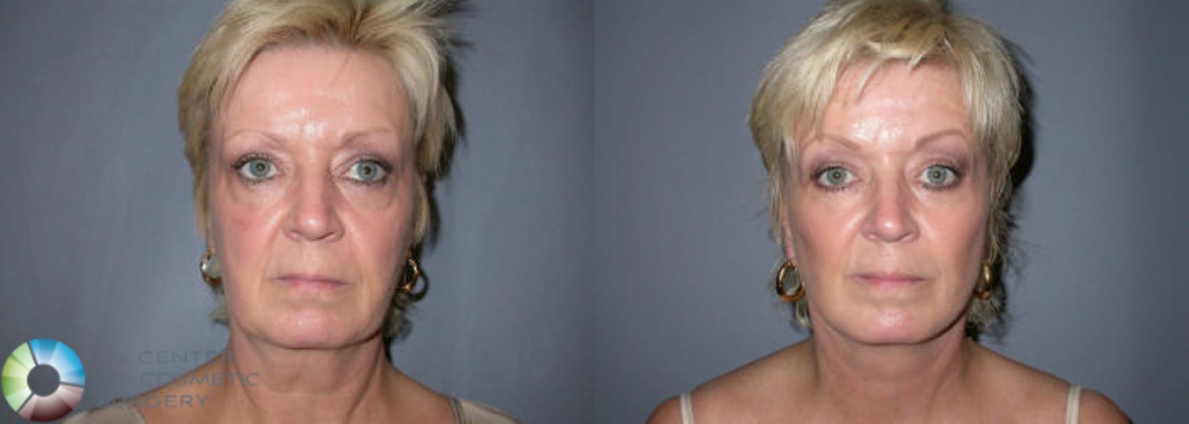 Before & After Mini Facelift Case 2 View #2 View in Denver & Golden, CO
