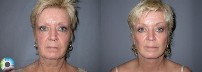Before & After Eyelid Lift Case 2 View #2 View in Golden, CO