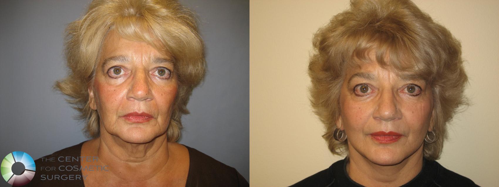 Before & After Facelift Case 225 View #1 in Denver and Colorado Springs, CO