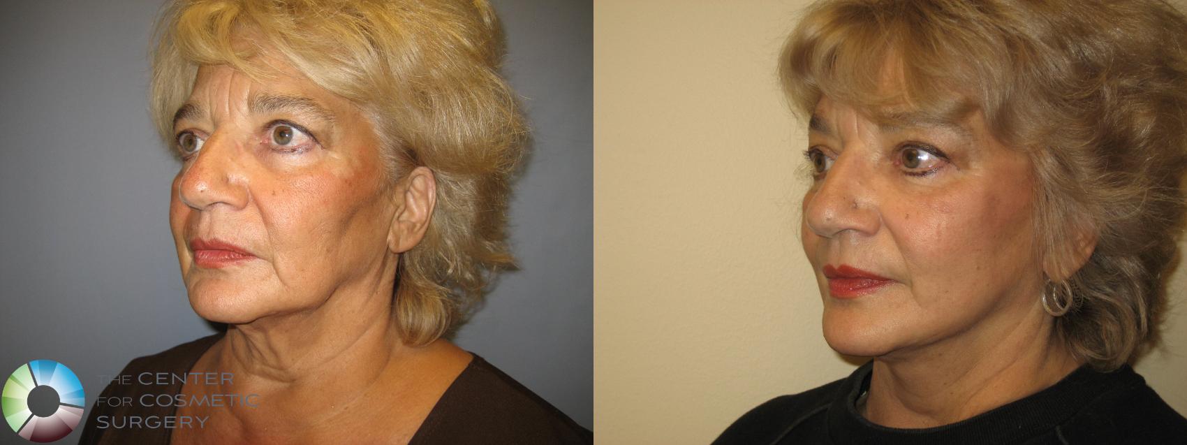 Before & After Mini Facelift Case 225 View #2 View in Golden, CO