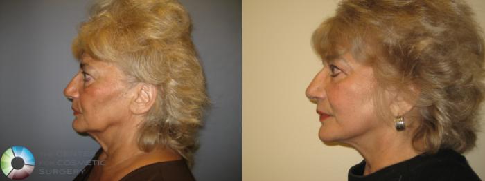 Before & After Mini Facelift Case 225 View #3 View in Golden, CO