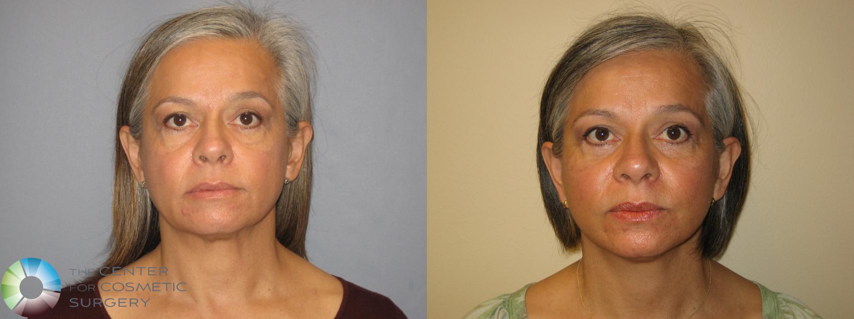 Before & After Mini Facelift Case 226 View #1 in Denver and Colorado Springs, CO