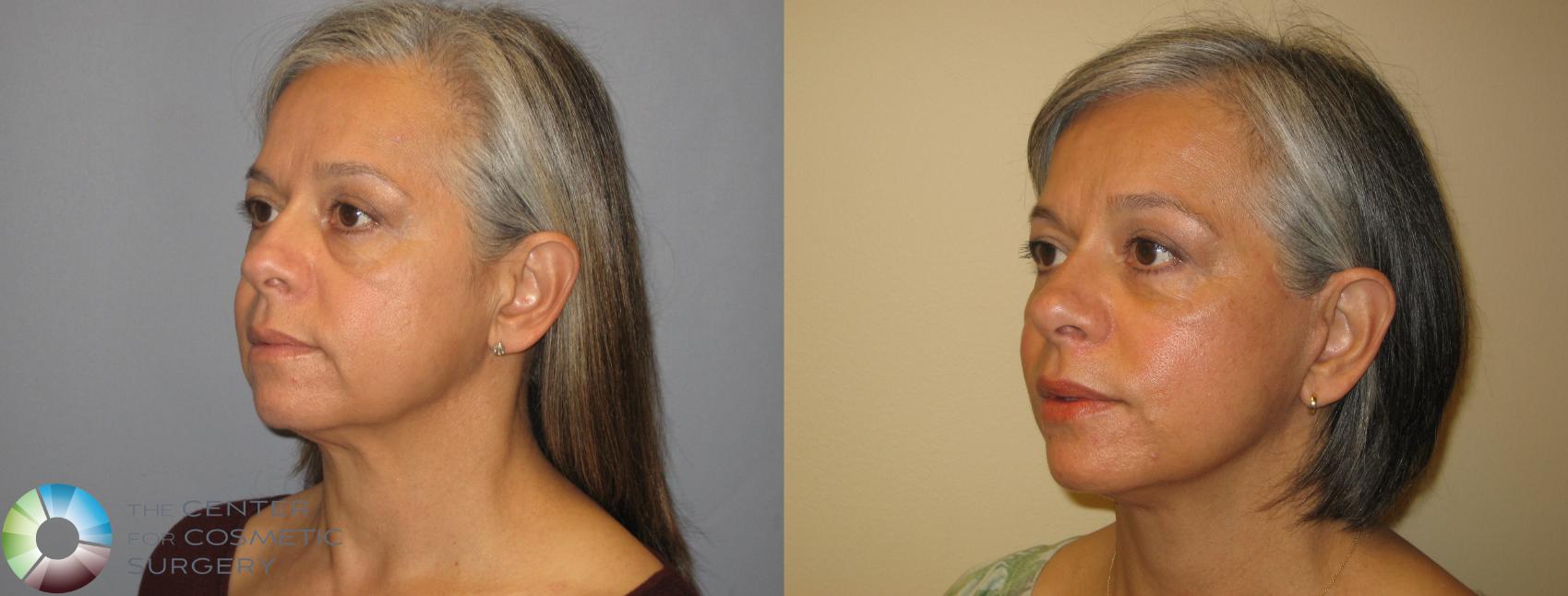 Before & After Mini Facelift Case 226 View #2 View in Golden, CO