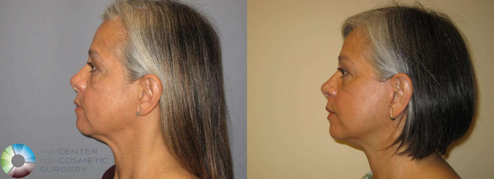 Before & After Mini Facelift Case 226 View #3 View in Golden, CO