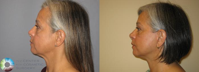 Before & After Eyelid Lift Case 226 View #3 View in Golden, CO
