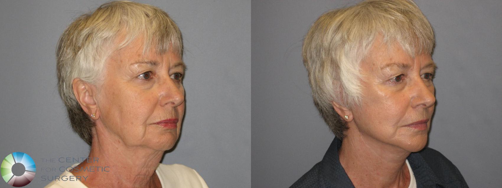 Before & After Facelift Case 235 View #1 in Denver and Colorado Springs, CO