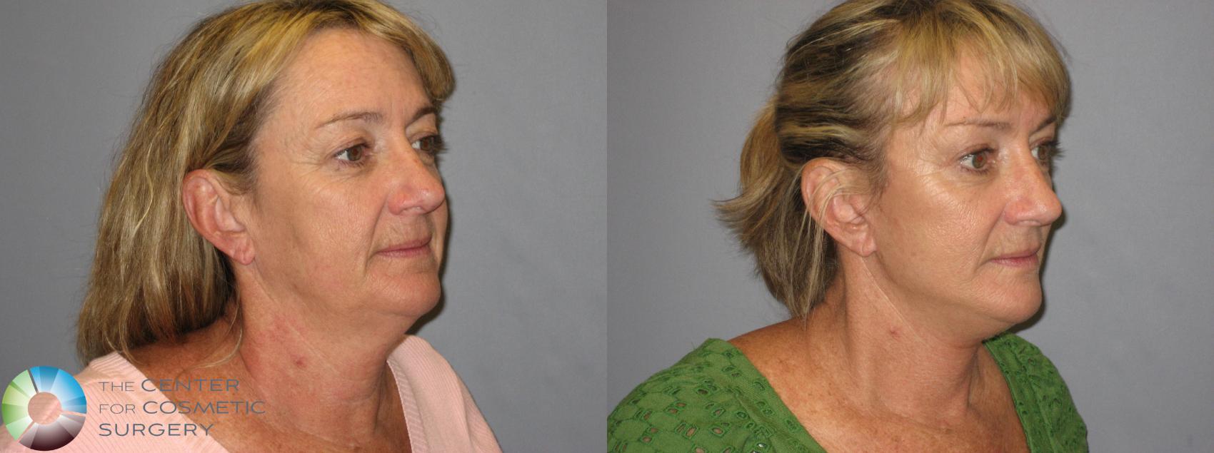 Before & After Mini Facelift Case 243 View #2 in Denver and Colorado Springs, CO