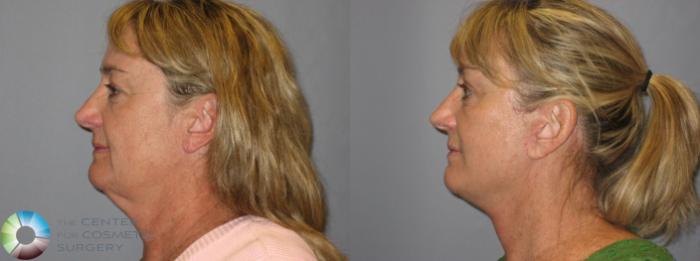 Before & After Mini Facelift Case 243 View #3 View in Golden, CO
