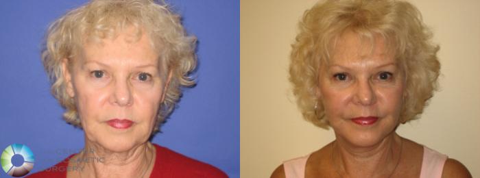 Before & After Eyelid Lift Case 250 View #1 View in Golden, CO