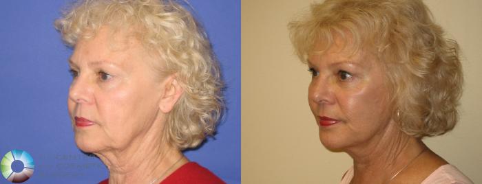 Before & After Eyelid Lift Case 250 View #2 View in Golden, CO