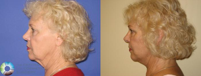 Before & After Mini Facelift Case 250 View #3 View in Golden, CO