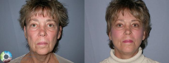 Before & After Facelift Case 26 View #1 View in Golden, CO