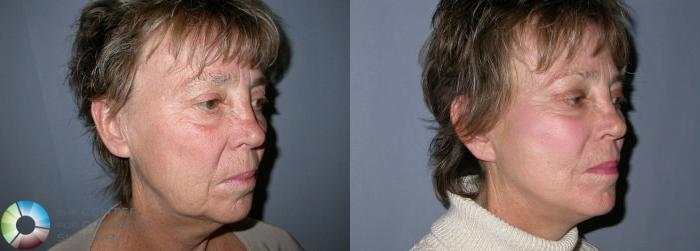 Before & After Mini Facelift Case 26 View #2 View in Golden, CO
