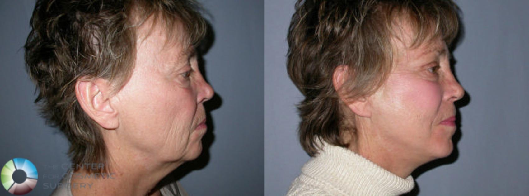 Before & After Mini Facelift Case 26 View #3 in Denver and Colorado Springs, CO