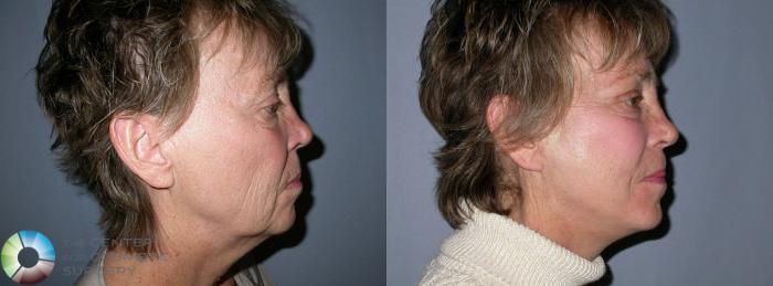 Before & After Mini Facelift Case 26 View #3 View in Golden, CO