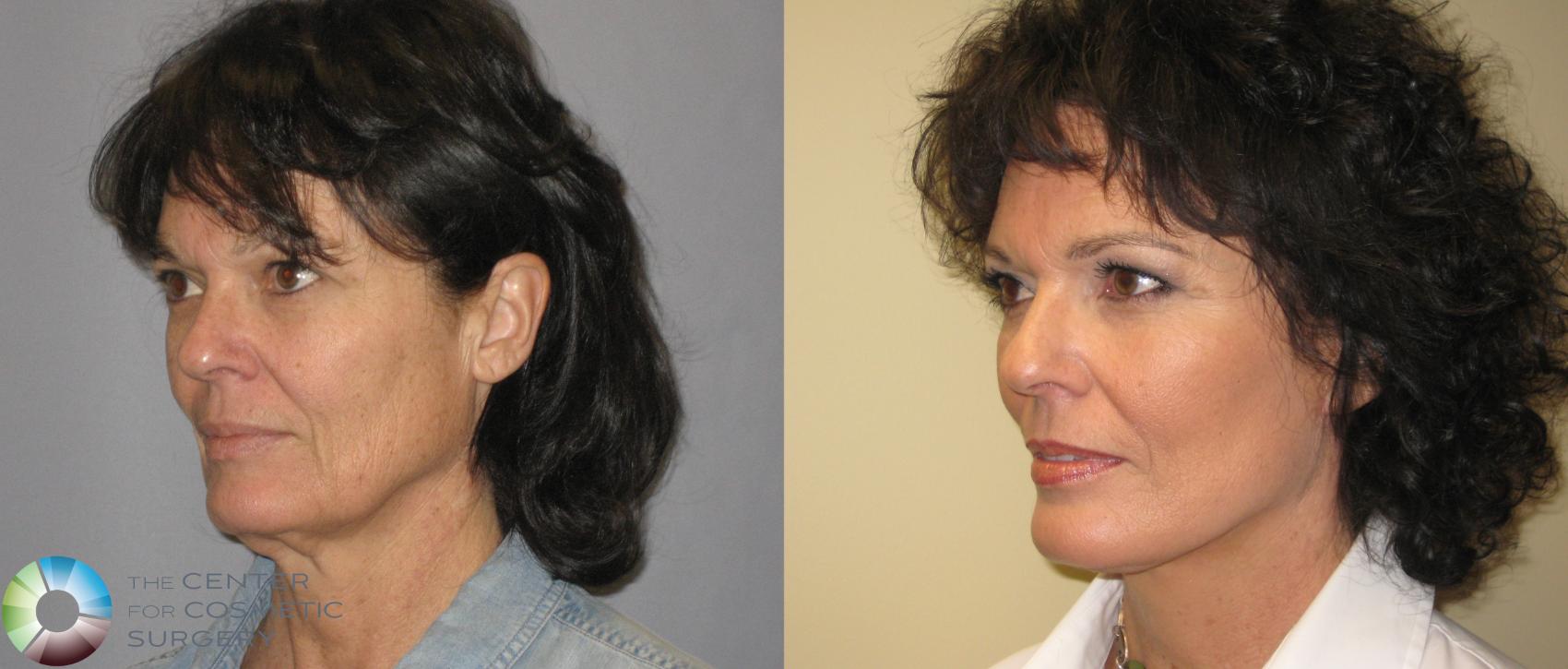 Before & After Neck Lift Case 287 View #2 View in Denver & Golden, CO