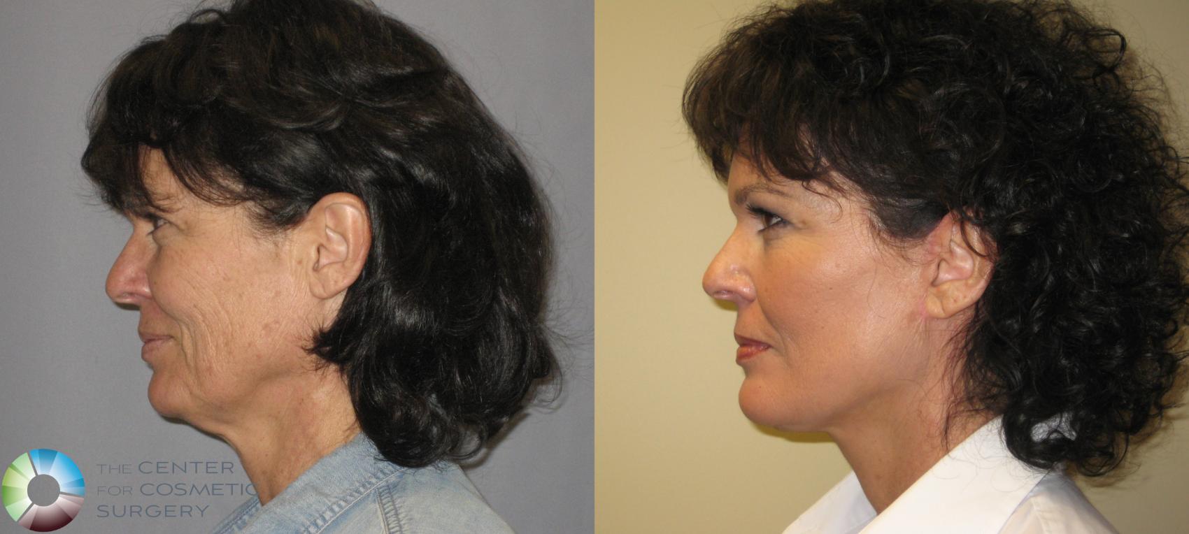 Before & After Mini Facelift Case 287 View #3 View in Golden, CO