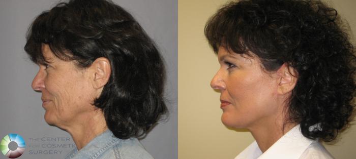 Before & After Neck Lift Case 287 View #3 View in Golden, CO