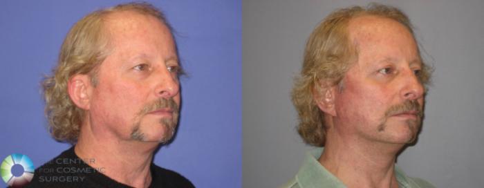 Before & After Mini Facelift Case 303 View #2 in Denver and Colorado Springs, CO